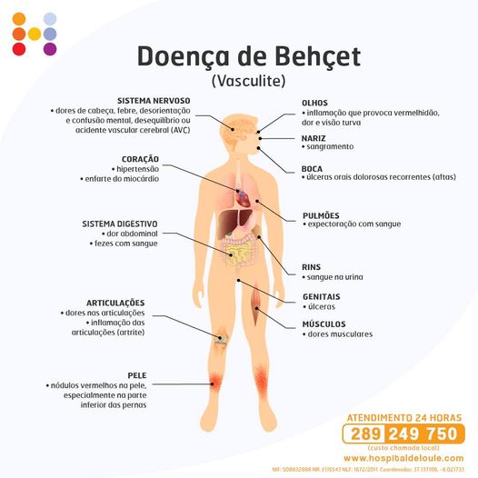 Behcet's disease