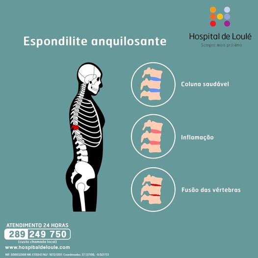 Do you know what ankylosing spondylitis is?